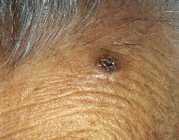 Carcinoma Basocelular Carcinoma Basocelular