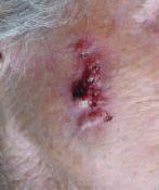 Carcinoma Espinocelular Carcinoma Espinocelular