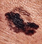 Melanoma Maligno Melanoma Maligno