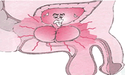 Prostatite, ou hiperplasia Benigna de Próstata. prostatite
