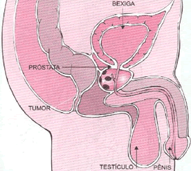 Câncer de Próstata. Tumor maligno na próstata